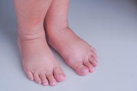Various Reasons the Feet May Become Swollen