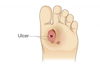 Help for Non-Healing Diabetic Foot Ulcers