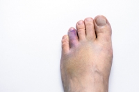 How Is a Broken Toe Diagnosed?