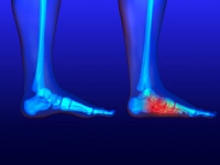 What Is the Difference Between Flat Feet and High Arches?